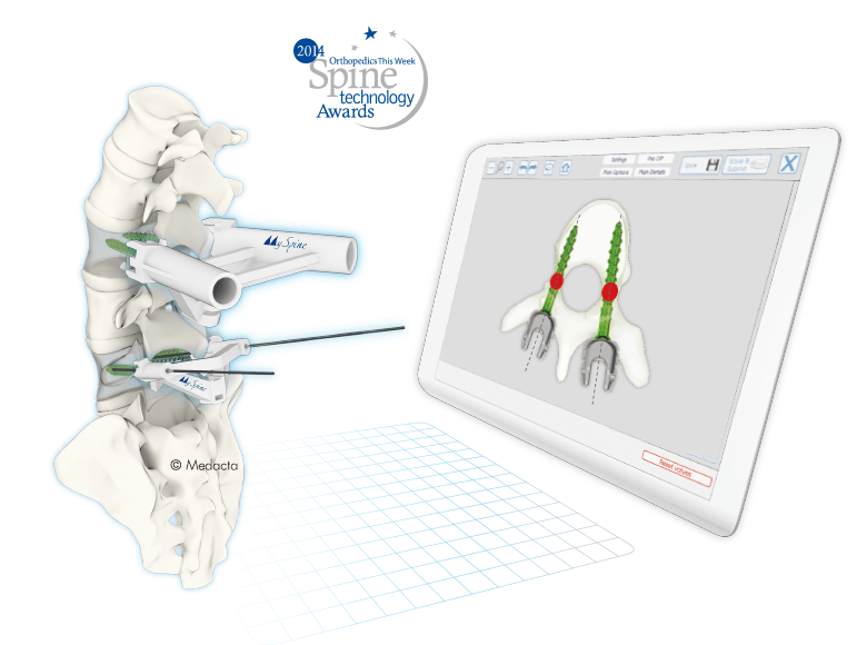 Medacta MySpine Operations Planung und 3D Druck für Wirbelsäulenoperationen